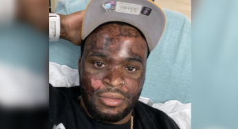 (Exclusive) Man With $500k Lawsuit Against ATL Esthetician Over Second Degree Burns Speaks Out #TSRInvestigates
